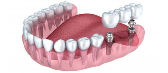 implant dentaire