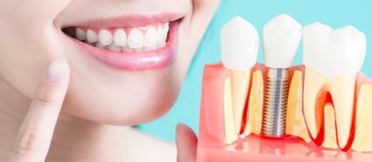 Prothèses et implants dentaires