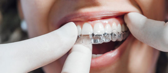 Le traitement Invisalign