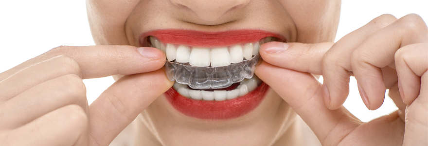 orthodontie solutions invisibles