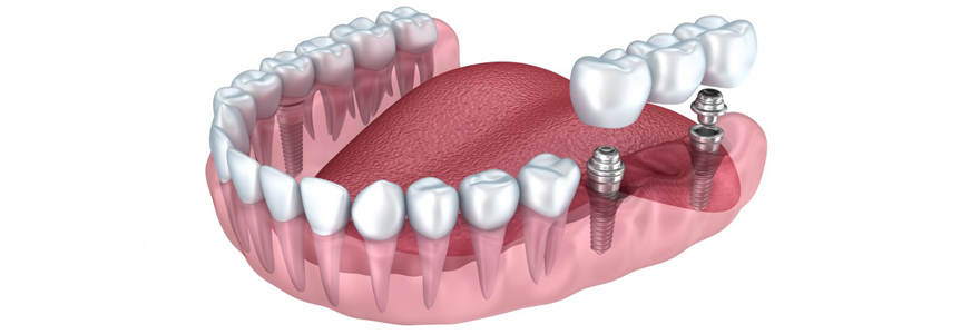 implant dentaire