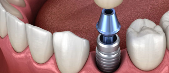 les avantages des implants dentaires