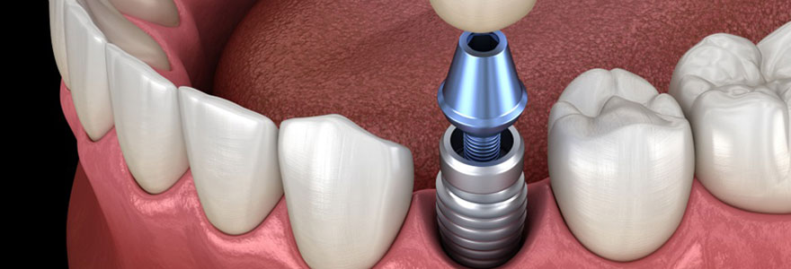 les avantages des implants dentaires
