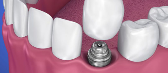 Implant dentaire
