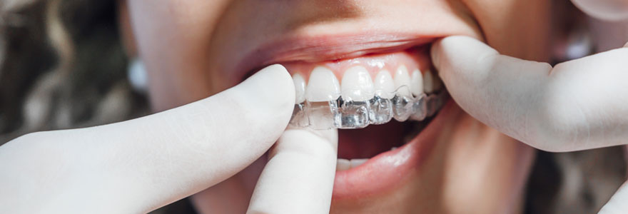 Le traitement Invisalign